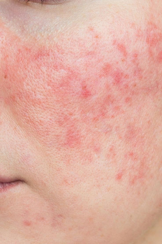Piel sensible/rosácea