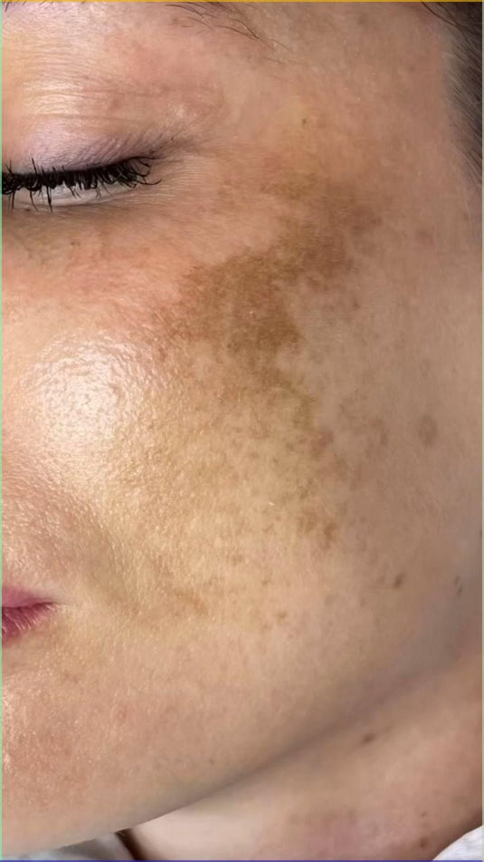 Manchas y tono desigual